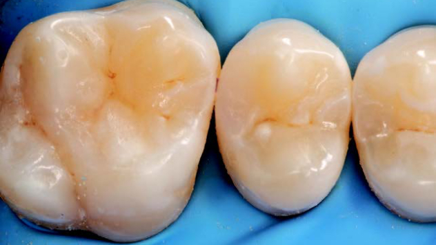 Posterior restoration after