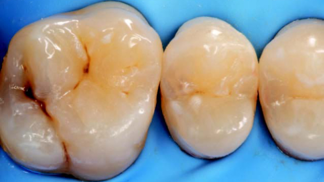 Posterior restoration before